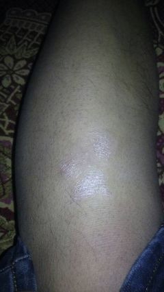 牛皮癬與軍校報考 正確認知與應對之道