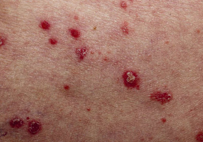 銀屑病點狀出血的原因及治療方法詳解