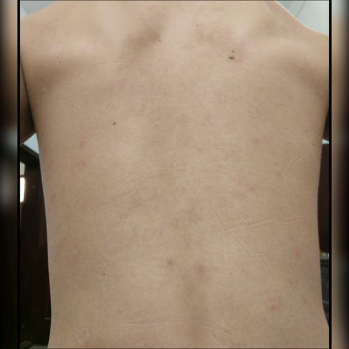 精神因素與牛皮癬（銀屑病）的關聯及應對策略