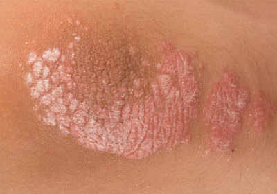 牛皮癬的類型及其臨床表現圖片指南