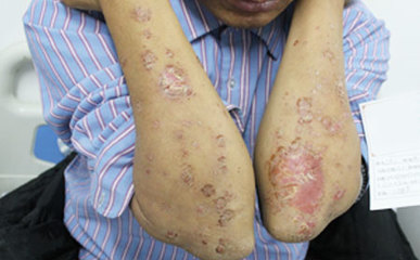 銀屑病春發高峰將至，防治要有效及時