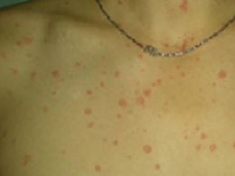 牛皮癬的癥狀與初期表現