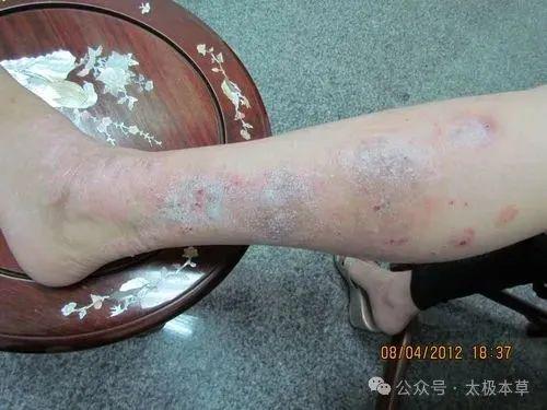 四大中醫名家治療牛皮癬的經驗名方