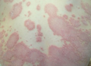 牛皮癬的治療方法與注意事項