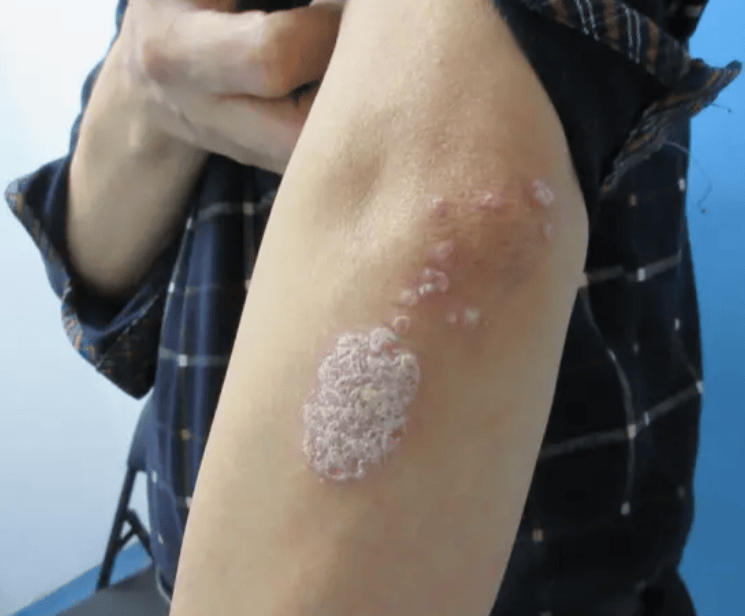 牛皮癬康復新篇 打破困局，解鎖無癢人生