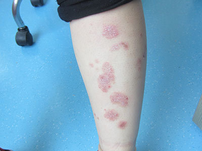 銀屑病（牛皮癬）患者的自我管理與生活建議