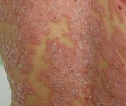 牛皮癬患者為何應避免食用生冷食物