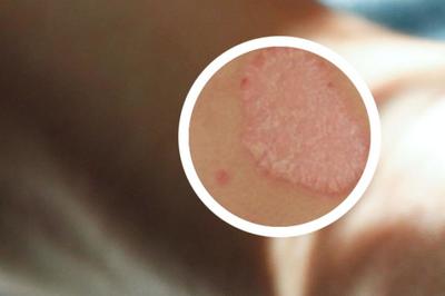 鴕鳥油在銀屑病（牛皮癬）治療中的認知與局限性