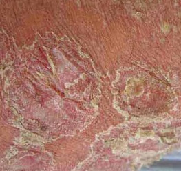 老年膿皰型牛皮癬的中醫用藥探析