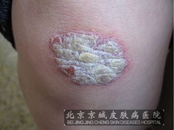 牛皮癬的病因與治療 從成因到北京專科醫院的建議