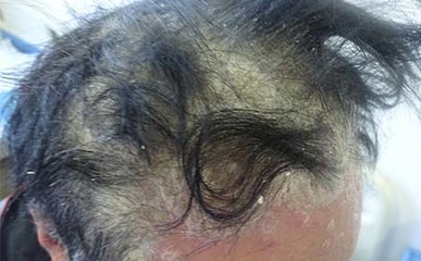 頭部銀屑病發生的主要原因探析