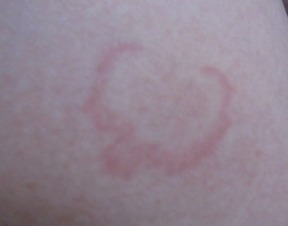 少年膿皰型牛皮癬的中醫病因探析