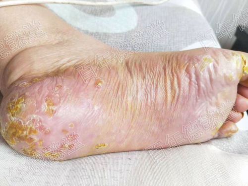 掌跖膿皰病與牛皮癬 異同解析