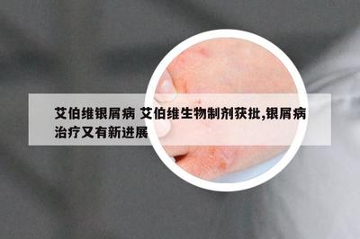 艾伯維生物制劑獲批，銀屑病治療迎來新突破