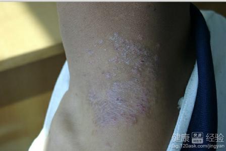 得了牛皮癬怎么辦？科學認識與應對之道