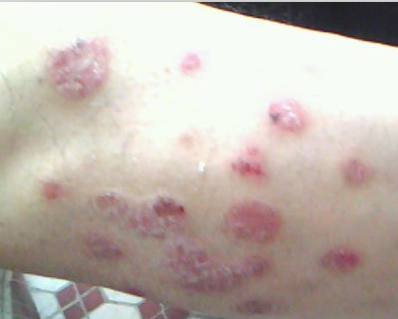 北京銀屑病權威診療機構推薦與就醫指南