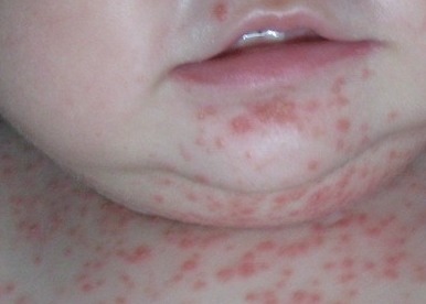 嬰兒牛皮癬與遺傳因素 揭開背后的科學聯系