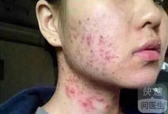 面部牛皮癬的科學治療與有效護理方法